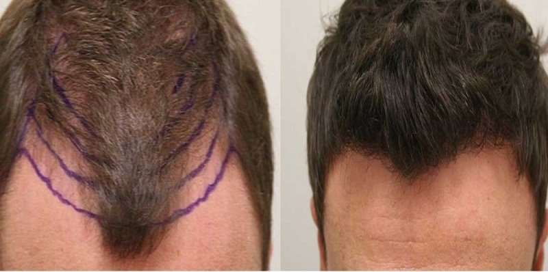 صورتان مرجعيتان قبل وبعد زراعة الشعر بحسب المصدر